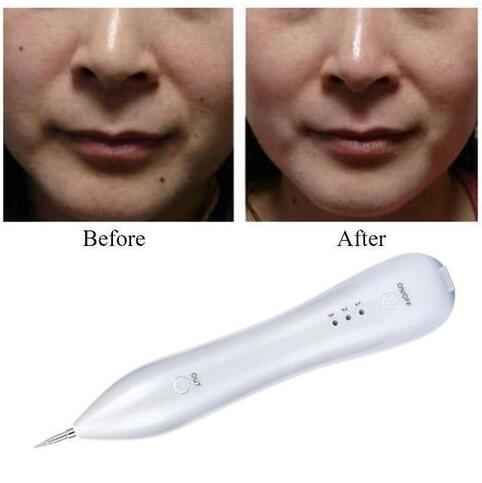 Perssia SpotPerfect™ Precision Skin Tool Mole Removal Pen